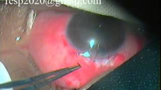 Releasable Suture In Trabeculectomy Glaucoma Surgery By Dr Sudhir Singh 34 [upl. by Ricoriki]