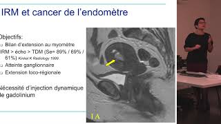 Decembre 2017  Cancer de lendomètre [upl. by Annaxor406]