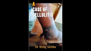 A case of Cellulitis Treated with Classical Homeopathy [upl. by Akihsar241]