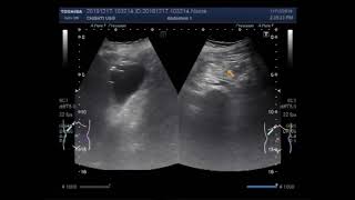 Ultrasound Video showing Hemoperitoneum  hematoperitoneum after 30 days of traumatic injury [upl. by Mehs947]