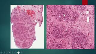 2024 09 16 Lobular Capillary Hemangioma Pyogenic Granuloma [upl. by Koah]