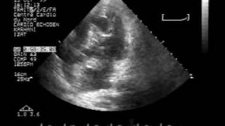 Echocardiogram Hydatid cyst in the interventricular septum apical view [upl. by Trista]