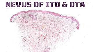 Nevus of Ito Ota Sun Hori amp Dermal Melanocytosis quotMongolian Spotquot under the microscope dermpath [upl. by Lyram]