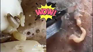 Ultimate Pimple Popping Compilation  Extreme Acne Treatment  Satisfying Blackhead Removal [upl. by Renruojos253]