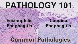 Eosinophilic Esophagitis amp Candida Esophagitis  Pathology 101 GI Pathology [upl. by Nnov25]