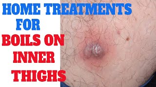 Home remedies to get rid of boils on inner thighs  treatments for boils on skin  boils on buttocks [upl. by Irene]