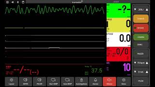 Ventricular fibrillation [upl. by Hairabez]