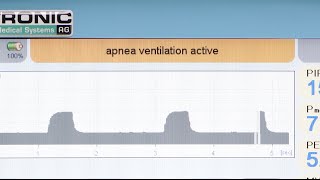 fabian HFO PSV Pressure Support Ventilation and Apnea Ventilation [upl. by Mayer267]