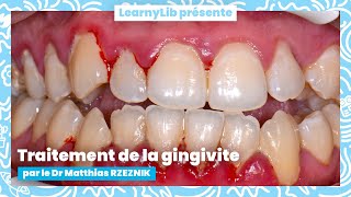 🦷 La parodontie  traitement de la gingivite avec le Dr Matthias RZEZNIK [upl. by Aicekat513]