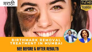 मराठी Birthmark Removal Laser amp Permanent Birthmark Removal Treatment in Mumbai Skin Specialist [upl. by Ruhnke214]