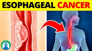 Top 10 Early Warning Signs of Esophageal Cancer  NEVER Ignore THIS [upl. by Lokcin]