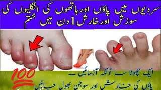 Feet Swelling Treatment Paon ki Sojan Ka ilaj  Chilblains treatment at home  Home Remedies [upl. by Klingel]