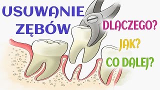 USUWANIE ZĘBÓWDŁUTOWANIEEKSTRAKCJA ÓSEMKIMOJE RADY [upl. by Salomone38]