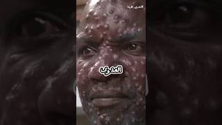 جدري القردة 😱🦠 [upl. by Selrhc]