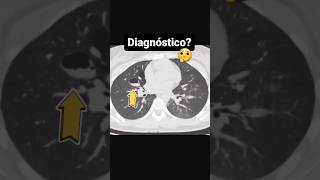 2 hallazgos para hacer el diagnóstico ✅🔥 radiologia radiologo short radiologia [upl. by Fidelia526]