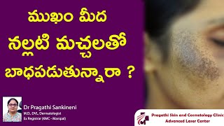 ముఖం మీద నల్లటి మచ్చలతో బాధపడుతున్నారా  facial melanosis  Dr Pragathi  Dermatologist  Nizamabad [upl. by Anaeli]