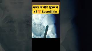 Sacroiliitis Pain in Young 🔥🔥 कमर के नीचे हिस्से में दर्द की समस्या sacroileitis sacroiliacjoint [upl. by Keating900]