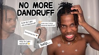 HOW TO GET RID OF DANDRUFF [upl. by Venterea]