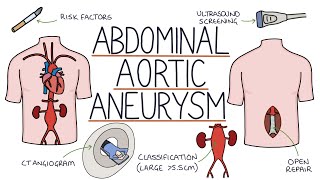 Understanding Abdominal Aortic Aneurysms [upl. by Haibot]