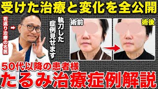 50代以降のたるみ治療の症例！受けた治療や変化を全てお見せします。 [upl. by Yram27]