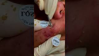 blackhead removal acne blackhead blackremoval [upl. by Attevaj]