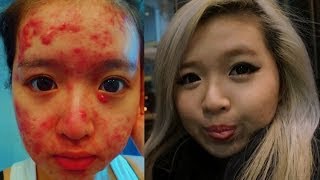 My Acne Story  Accutane FAQ [upl. by Naujat]