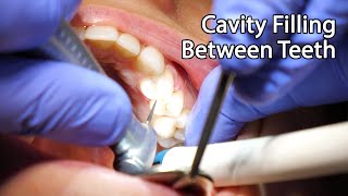 Dentist Filling A Cavity Between Teeth [upl. by Pierson]