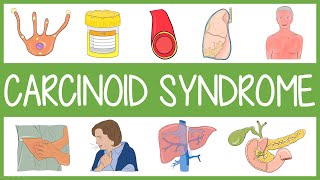 Carcinoid Syndrome in 3 Minutes [upl. by Nosnhoj]