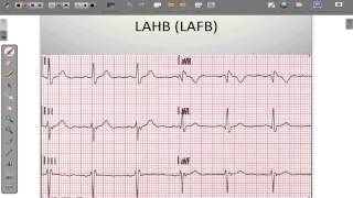 ECG 12 Lead Conduction System Abnormalities [upl. by Aisitel]