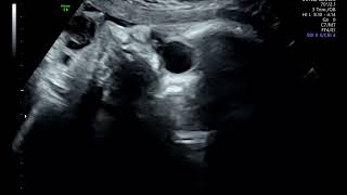 Bilateral Fetal Dacryocystocele  Ultrasound [upl. by Zzahc927]