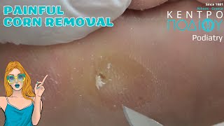 Corn Removal Αφαίρεση Τύλουcallus κεντροποδιου footcare podologos podiatrist podiatry [upl. by Philander]