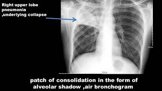 CASE 338 Right upper lobe pneumonia [upl. by Nnylekoorb]