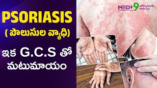 Psoriasis causes amp Treatment Telugu  Skin Infection skincare psoriasis [upl. by Ame]