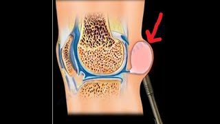 Bakers Cyst its relationship to meniscus tears and knee arthritis [upl. by Nniroc]