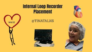 Heart Loop Recorder Insertion [upl. by Rhodie]