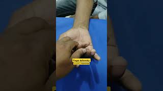 Finger deformity joints nerve physiotherapy anatomy stiffness movement wax pain ruhs nims [upl. by Htelimay711]