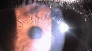 resolving herpetic stromal keratitis [upl. by Oflodor324]