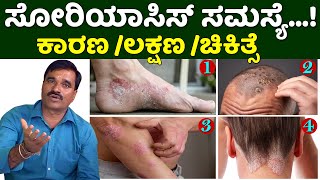 Psoriasis Treatment in Karnataka  Soriyas Disease Treatment Kannada  Nati Vaidya Neelakantha [upl. by Carmelita]