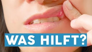 Tipps zur Mundpflege Das hilft gegen Aphthen [upl. by Niram]