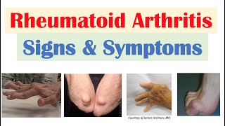 Rheumatoid Arthritis RA Signs amp Symptoms amp Associated Complications [upl. by Atiuqer447]