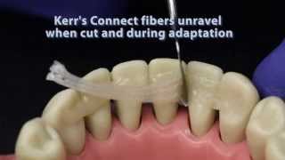 Ribbond compared to other dental fiber reinforcement materials [upl. by Flosser]