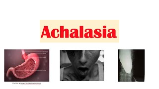 Achalasia  Pathophysiology Causes Signs amp Symptoms Diagnosis Treatment [upl. by Damales]