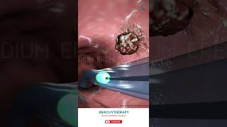 Know About Brachytherapy ↪ 3D Medical Animation Brachytherapy InternalRadiationTherapy [upl. by Yzzik]