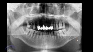 Apófisis cigomática y hueso malar Zygomatic Process and Zygomatic Bone [upl. by Nuyh975]