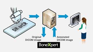 Bone age automated with BoneXpert AI  precise and easy [upl. by Nuawaj]