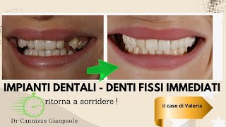 Impianto dentale su un singolo dente  Studio Cannizzo Milano [upl. by Ulrikaumeko]