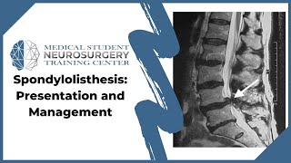 Spondylolisthesis Presentation and Management [upl. by Daryle995]