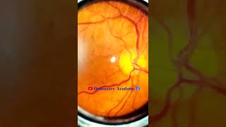 Normal fundus  Normal Retina  Smartphone Fundus Videography  Fundus Photography  Short Video 91 [upl. by Rey554]