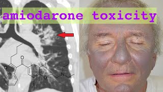 amiodarone toxicity [upl. by Wenona307]