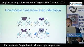 Gonioscopie en pratique Dr Yves Lachkar [upl. by Ire]